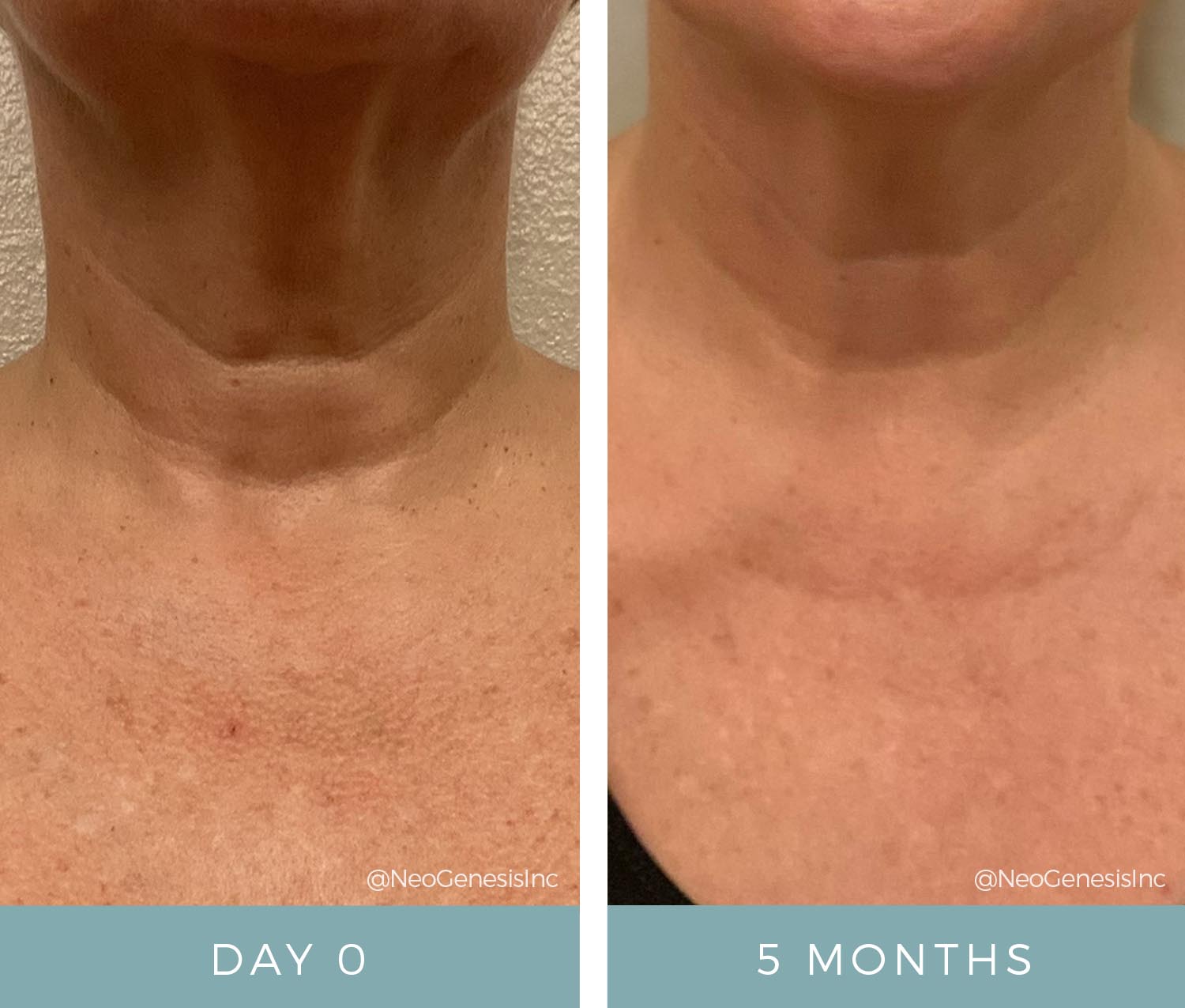 Before + After - Aging Neck