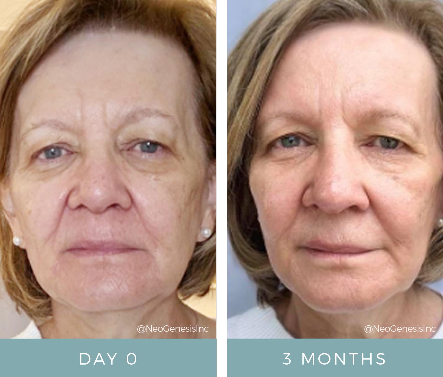 Before + After - Aging Skin Concerns